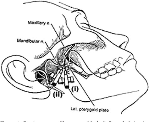 Figure 1 From Continuous Maxillary And Mandibular Nerve Block For