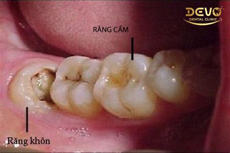 Cách Phân Biệt Răng Cấm Và Răng Khôn Như Thế Nào Devo Dental Chuỗi