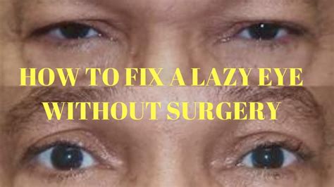 How To Fix A Lazy Eye Without Surgery Lazy Eye Exercise Youtube
