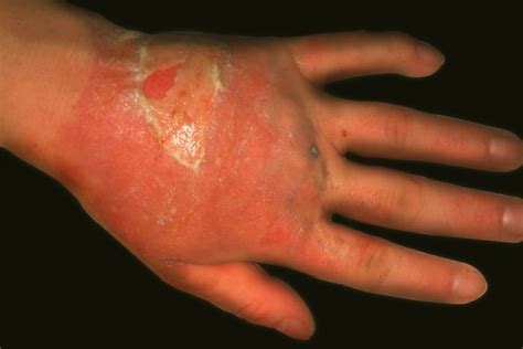 What You Need To Know About Psoriasis Vs Eczema Hubpages