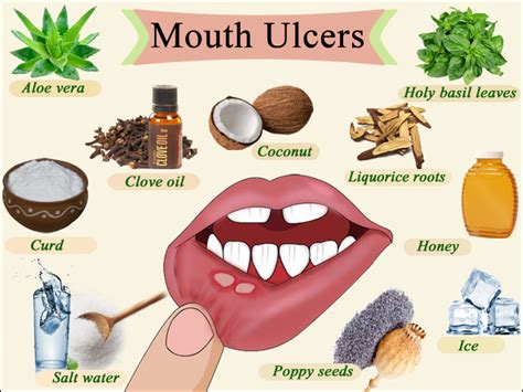 Natural Remedies For Mouth Ulcers Dental Galaxy