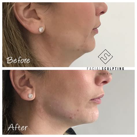 Jawline Fillers Facial Sculpting Jawline Fillers Specialist In London