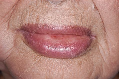 Angioedema Of The Lower Lip Due To Drug Reaction Stock Image C