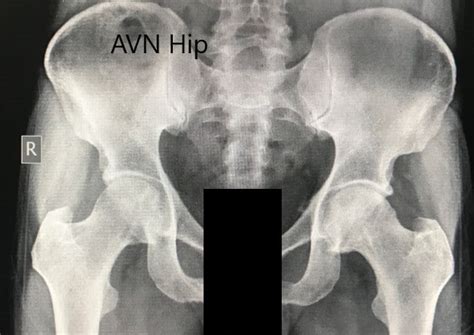 Case Study Bilateral Total Hip Replacement In 58 Yr Old Male