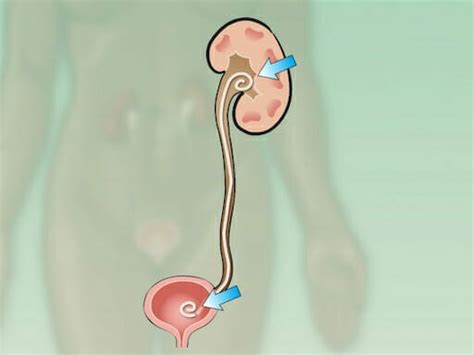 How To Get Comfortable With A Kidney Stent Tons Of How To