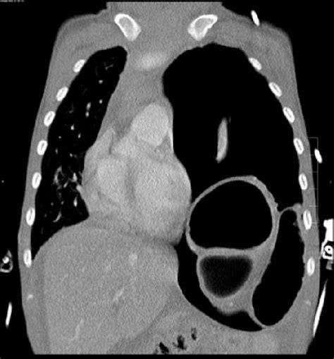 Thoracic Ct Scan On Admission Left Sided Tension Pneumothorax With