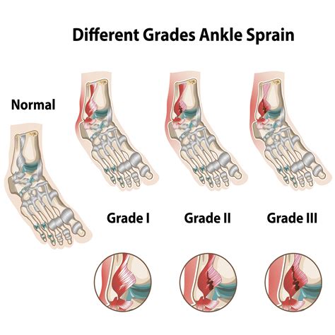 Laser Therapy For Ankle Sprain — Chiropractor Nashville Tn