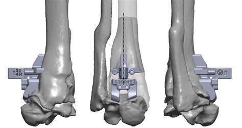Total Ankle Replacement David Shepherd