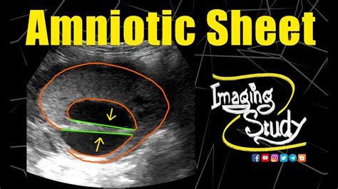Amniotic Sheet Amniotic Shelf Ultrasound Case 182 Youtube