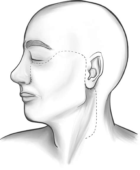 The Cervicofacial Flap Operative Techniques In Otolaryngology Head