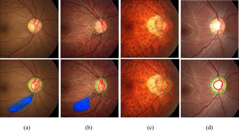 Examples Of Fundus Images Misdiagnosed By Junior Doctors And