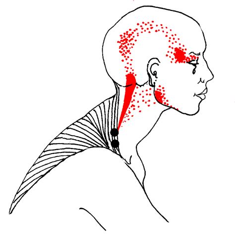 Common And Rare Diseases In Head And Neck Pain In Head And Neck