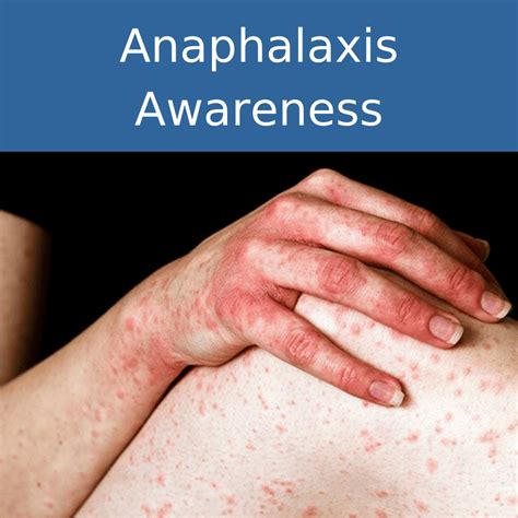 Anaphylaxis Online Training Cpd Accredited Caring For Care
