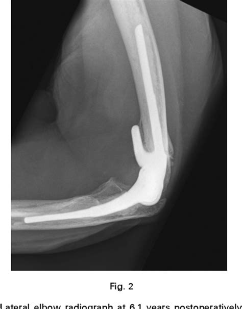 Figure 2 From Heterotopic Ossification Following Total Elbow