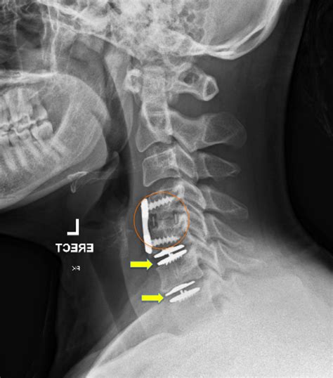 Cervical Spinal Salvage With Mobile Artificial Discs After Fusion
