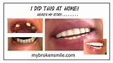 Home Tooth Repair Chipped Tooth Images