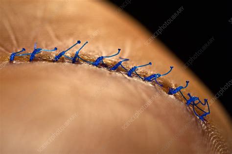 Surgical Sutures Stock Image C0119823 Science Photo Library
