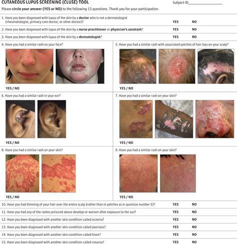 Development And Pilot Testing Of The Cutaneous Lupus