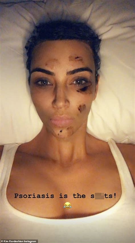 Kim Kardashian Shares Shocking Photo With Bloody Scars On Her Face