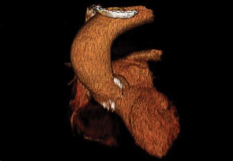 Thoracic Aortic Aneurysm How To Counsel When To Refer Consult Qd