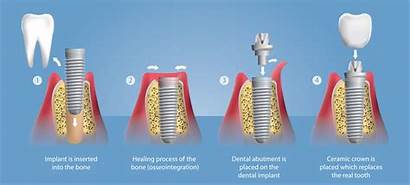 Implant Implants Dental Denti Zahnimplantat Implantat Zaehne