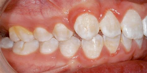 White Spots On Baby Teeth Healthmedline