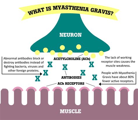 Myasthenia gravis (mg) is the most common neuromuscular junction disease and presents with weakness worsened by exertion but improving with rest. Bass faces Myasthenia Gravis, seeks treatment in Russia ...