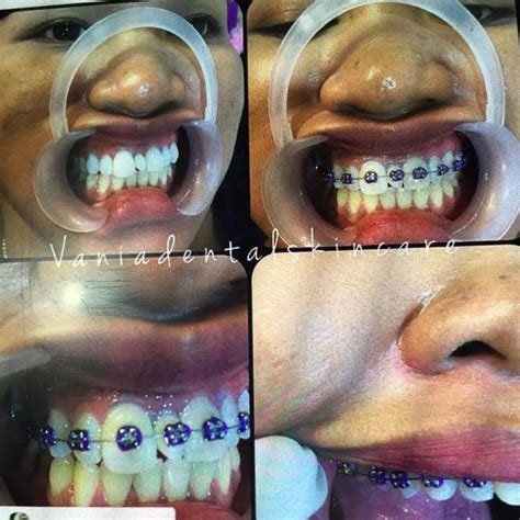 tukang gigi 4 – dental.id