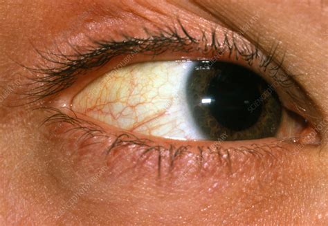 Yellowing Of Sclera Of Eye Due To Jaundice Stock Image M1900013