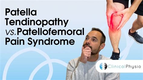 Patella Tendinopathy Vs Patellofemoral Pain Syndrome Expert Physio