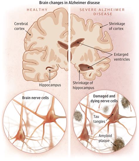 The test, created by researchers at washington university st louis, boasts 94 percent accuracy at predicting the devastating brain disease, they report. Alzheimer Disease. | Dementia and Cognitive Impairment ...