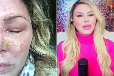 Rhobhs Brandi Glanville Blames Unrecognizable Face On Second Degree Burns As She Shares