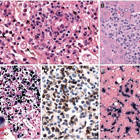 Primary Ebv Positive Nodal T And Nk Cell Lymphoma A Lymph Node