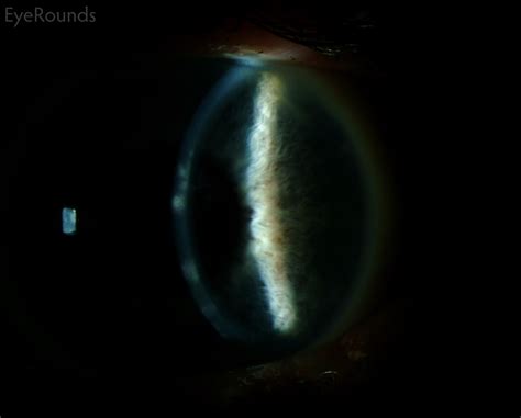 Topical therapy with acyclovir for hsv ocular infections is effective, but probably not superior to trifluridine (hovding, 1989). Herpes Simplex Keratitis