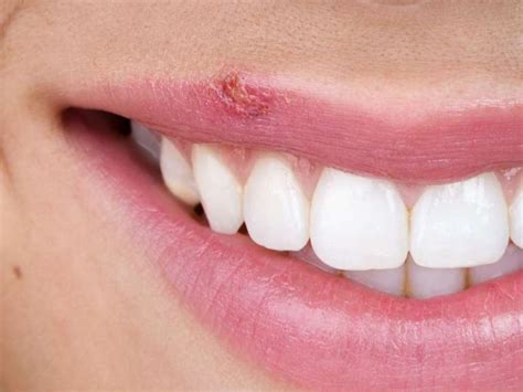 Cold Sores Symptoms Causes Risk Factors And Treatment Extrachai