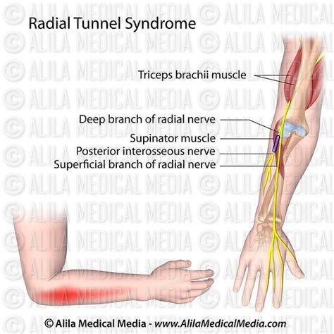 Alila Medical Media Radial Tunnel Syndrome Medical Illustration