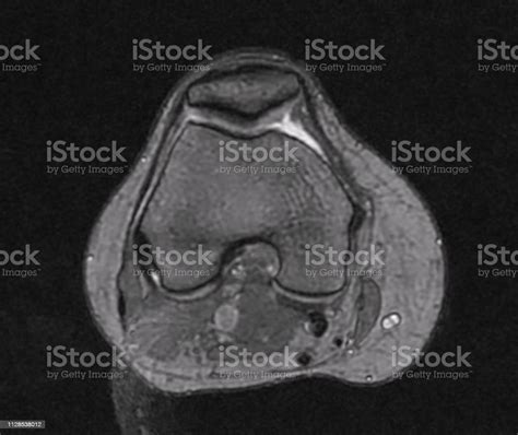 Knee Muscle Anatomy Mri Use The Mouse To Scroll Or The Arrows