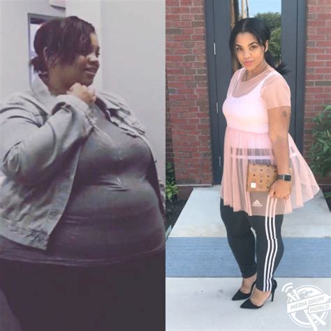 Incredible Woman Who Lost Eleven Stone In Fifteen Months After Weight Loss Surgery Media Drum