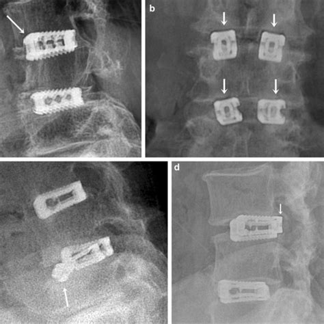 Implant Failures After Follow Up A Lateral Radiograph Showing