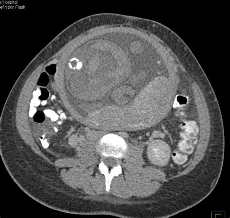 It remains common and continues to have significant morbidity in certain groups of patients. Acute Pyelonephritis in a Pregnant Patient - Kidney Case ...