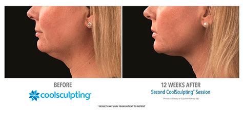 Coolsculpting Center In Whittier Under Chin Double Chin Reduction