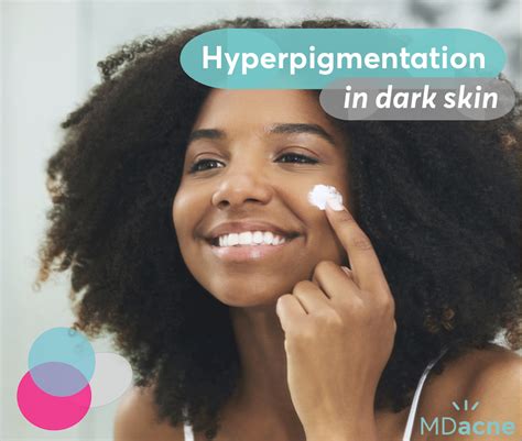 The good news is that skin hyperpigmentation isn't dangerous and hyperpigmentation treatment can help rejuvenate skin. The best hyperpigmentation treatment for black skin | MDacne