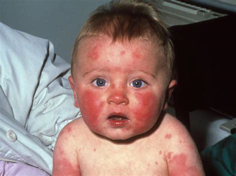 Childhood Rashes Skin Conditions And Infections Photo