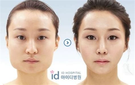 Before And After Photos Of Korean Plastic Surgery Pics Izismile Com