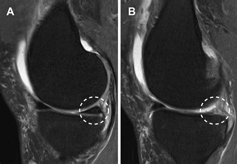 Injury Of The Meniscus Root Clinics In Sports Medicine