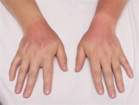 Rheumatoid Arthritis Medications Sun Exposure Rheumatology Advisor