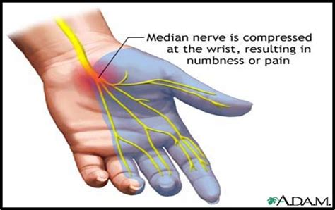 Carpal Tunnel Syndrome에 대한 이미지 검색결과 Median Nerve Carpal Tunnel