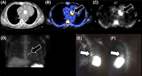 Cardiovascular Imaging In Infective Endocarditis Circulation