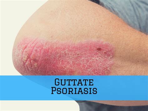 Guttate Psoriasis Causes Medical Treatment Home Remediesand Diet Tips