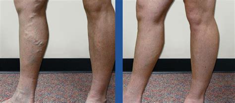 Vein Specialists Of The Carolinas Charlotte And Gastonia Locations